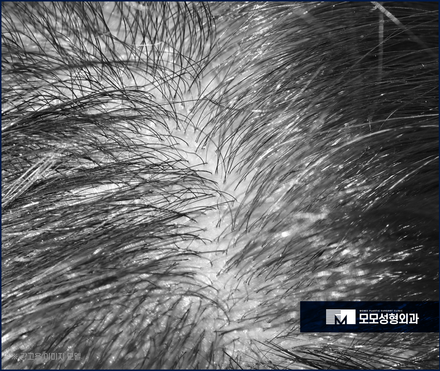 여자 옆머리 탈모 이유와 극복하고 채워가려면 관련 이미지 8