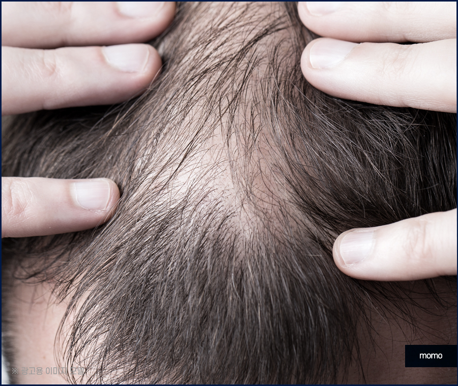 모발이식 생착기간 생착률 및 주의할 점 확인 관련 이미지 3