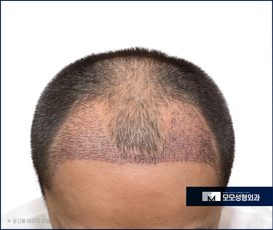 엠자탈모모발이식 자연스럽게 채워주는 관련 이미지 2