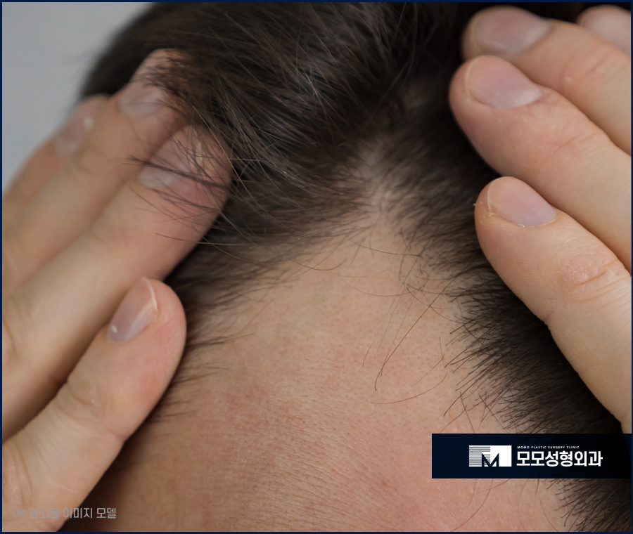 비절개모발이식가격 나에게 꼭 맞는 방향을 설정해서 관련 이미지 4