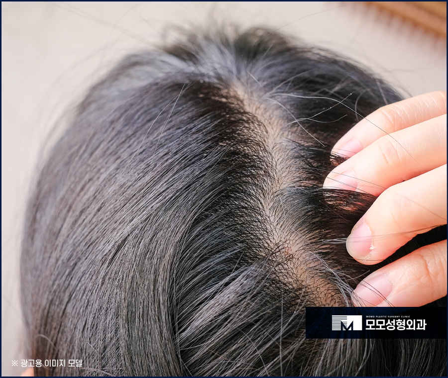 비절개모발이식 비용을 고민하기보다는 관련 이미지 2