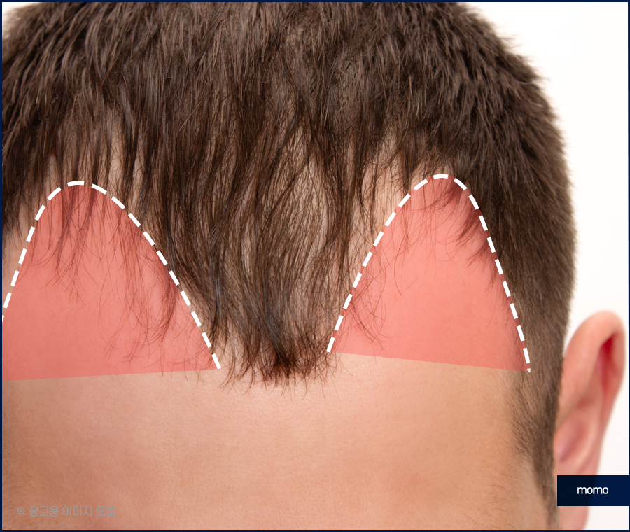 헤어라인모발이식비용 생착률을 높여가면서 관련 이미지 4