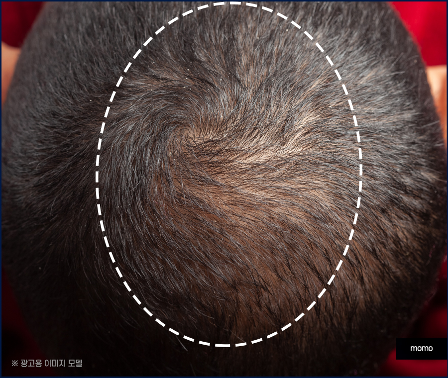 정수리 탈모 모발이식 섬세하게 채워가는 관련 이미지 9