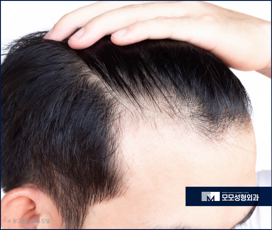 헤어라인모발이식비용 찾아볼 때 참고할 점은 관련 이미지 3