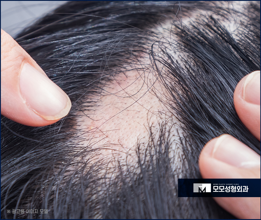 스트레스성탈모 나타나게 된 원인은 관련 이미지 2
