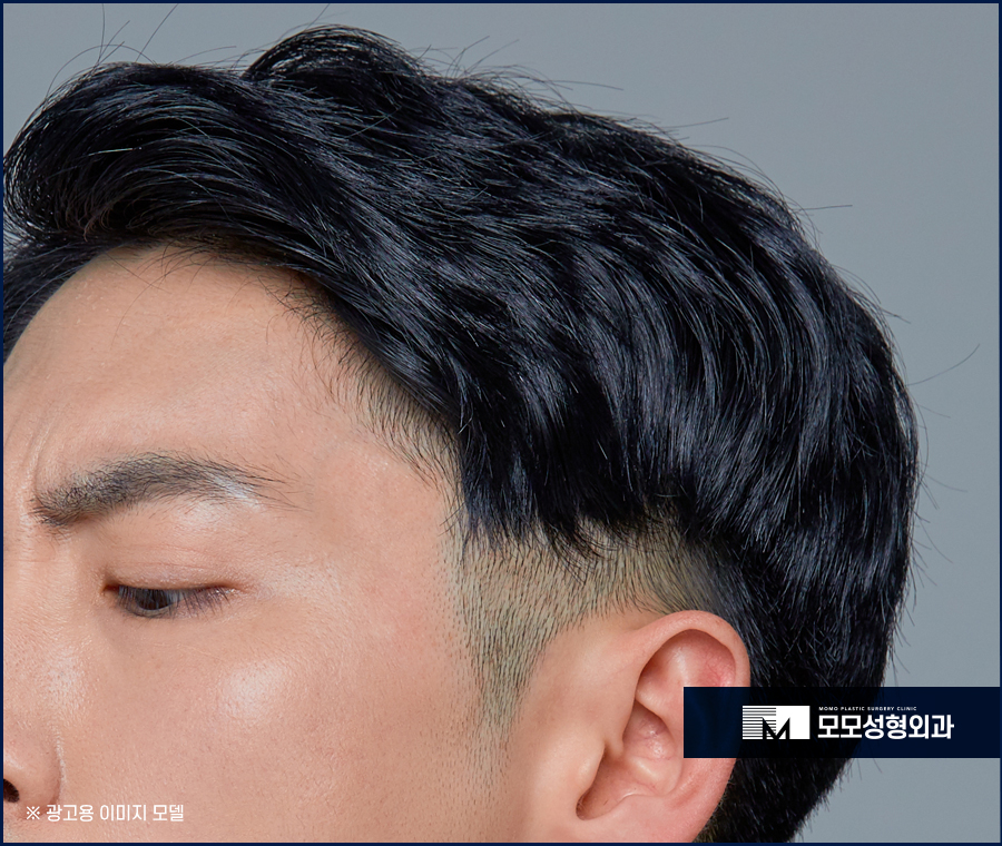 모발이식잘하는곳 누가 봐도 자연스러운 관련 이미지 2