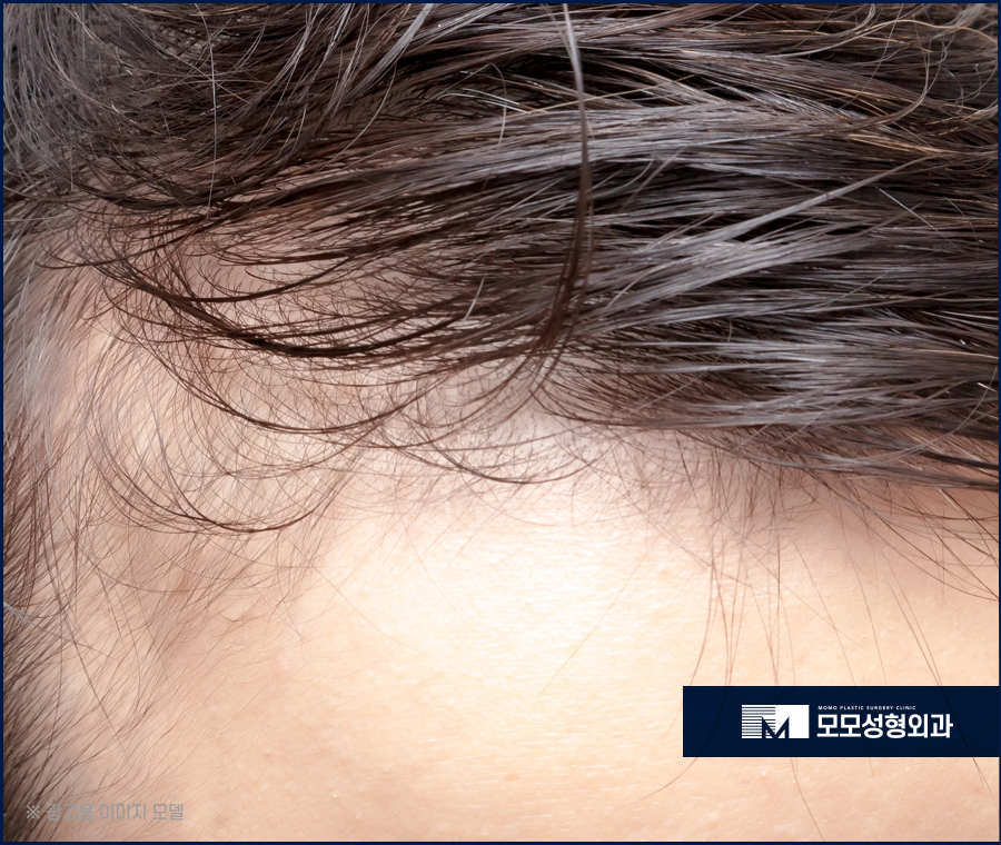 모발이식 1년이 지났을 때 경과가 좋으려면 관련 이미지 5