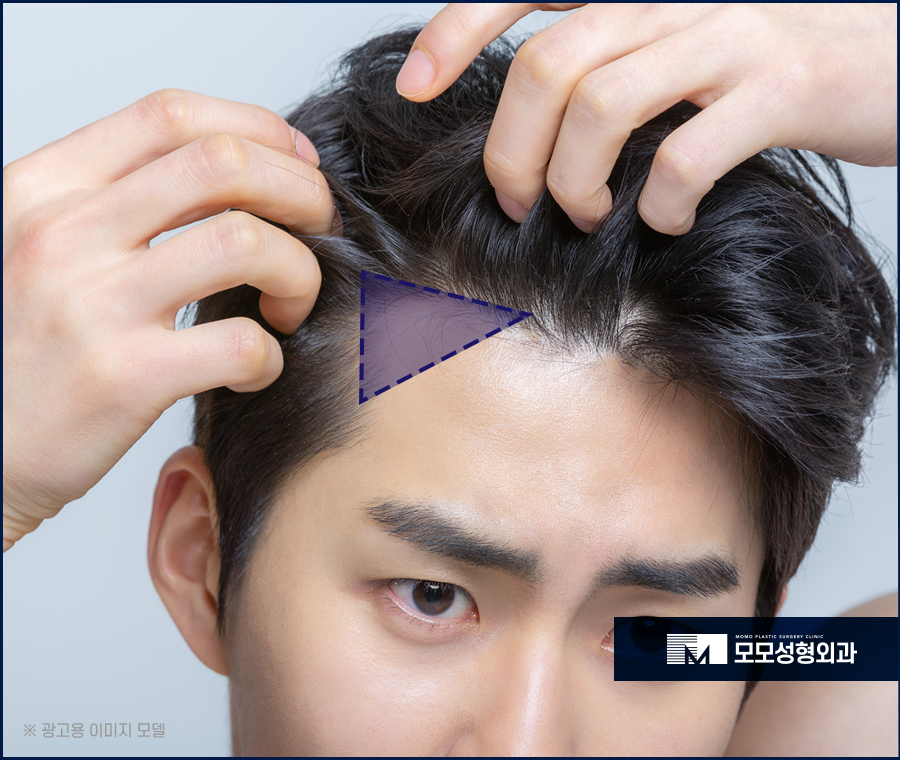 남자엠자탈모 극복을 위한 방향을 잘 잡아야만 관련 이미지 5