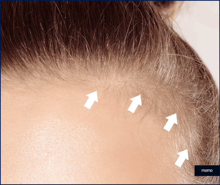 헤어라인 모발이식 비용보다 꼼꼼히 알아볼 조건은? 관련 이미지 7