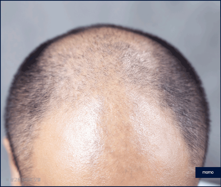 남자 모발이식 비용, 방법까지 꼼꼼히 확인하세요! 관련 이미지 9