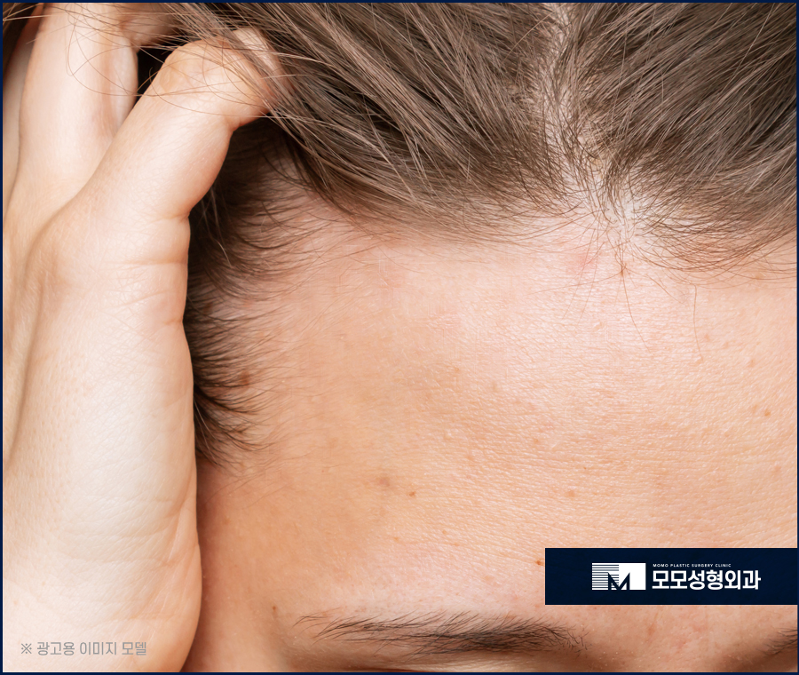 여성헤어라인모발이식 보강이 필요하다면 관련 이미지 4