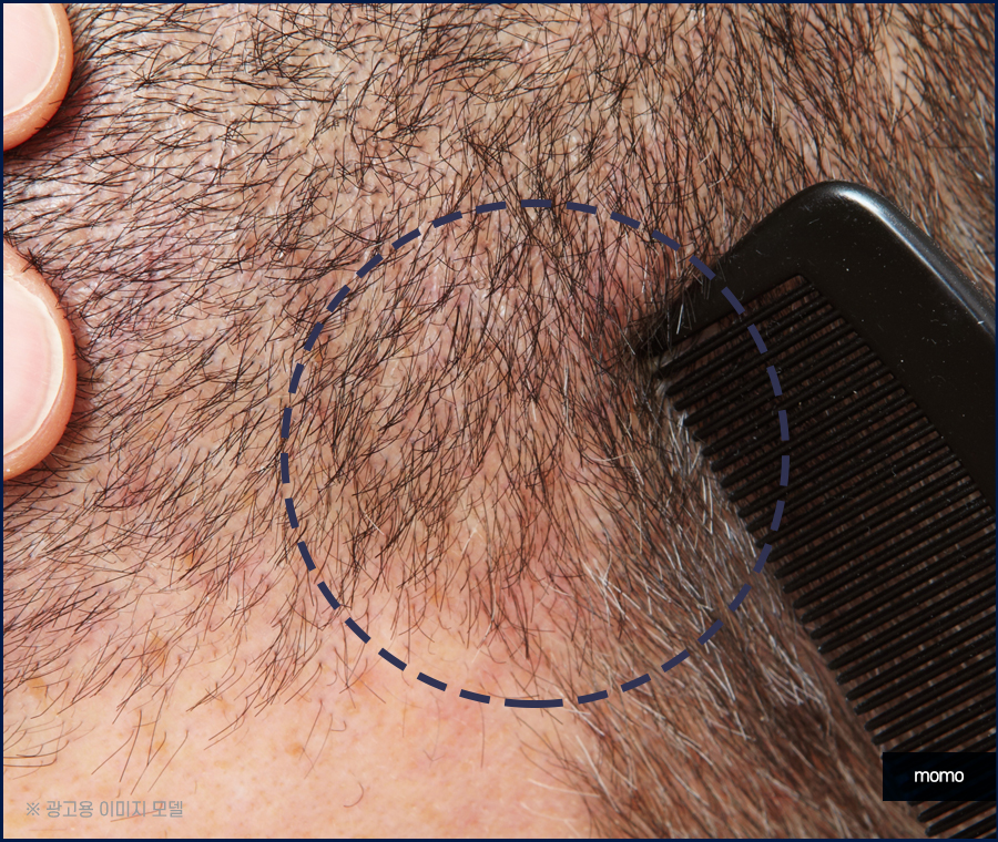비절개 모발이식 비용 무삭발로 회복까지 빠르게 관련 이미지 9