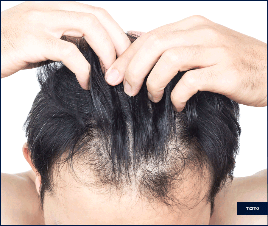 강남 모발이식 성공적인 변화를 만드는 꿀팁 관련 이미지 5