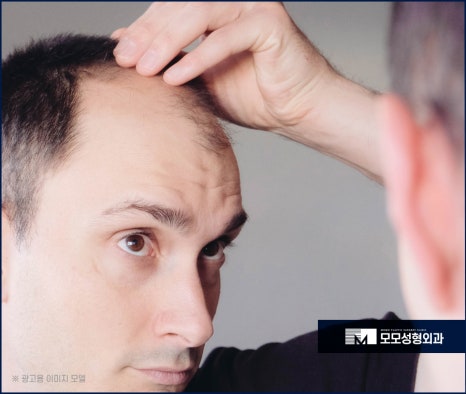 머리심는비용 비절개가 선호되는 이유에 대해 관련 이미지 3