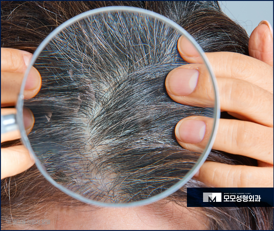 흰머리나는시기와 이유에 대해서 알아봅니다 관련 이미지 3