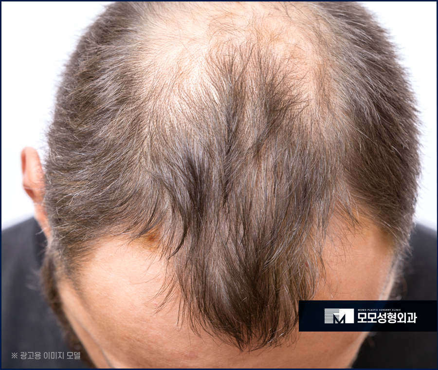신사모발이식 단순히 채운다는 개념을 넘어 관련 이미지 3