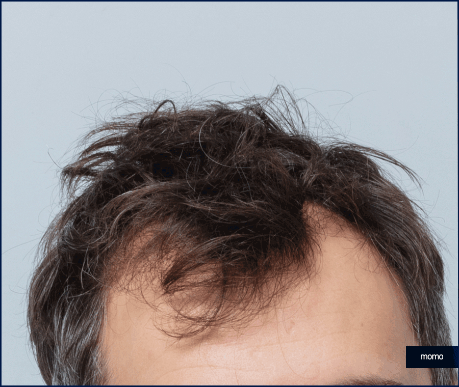 모발이식 금액 개인마다 차이가 나는 이유 관련 이미지 11
