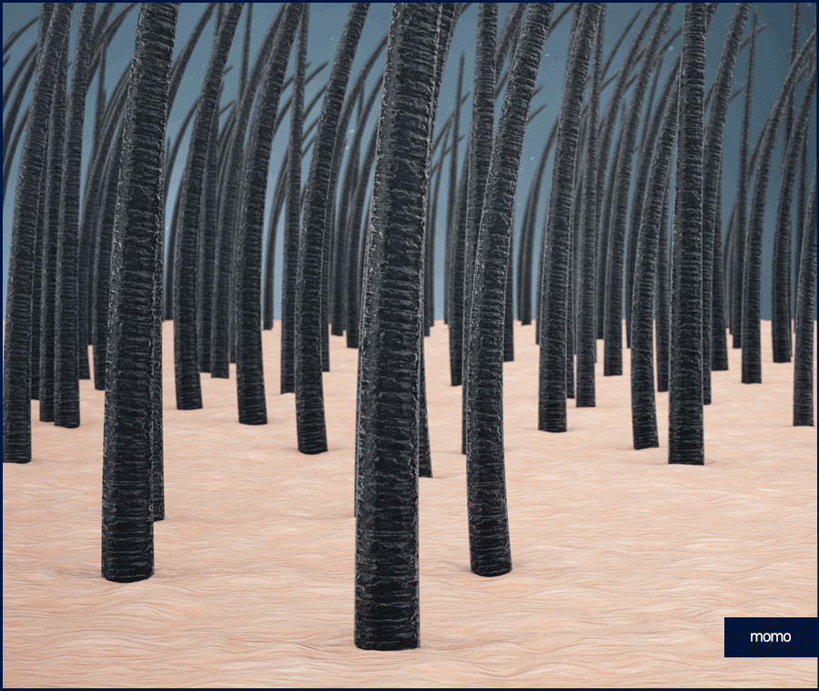 이마 축소술 비용 및 모발이식이 선호되는 이유 관련 이미지 3