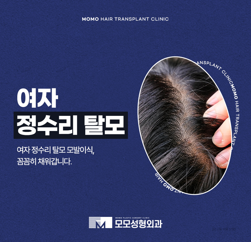 여자 정수리 탈모 모발이식 꼼꼼히 채우는 관련 이미지 1