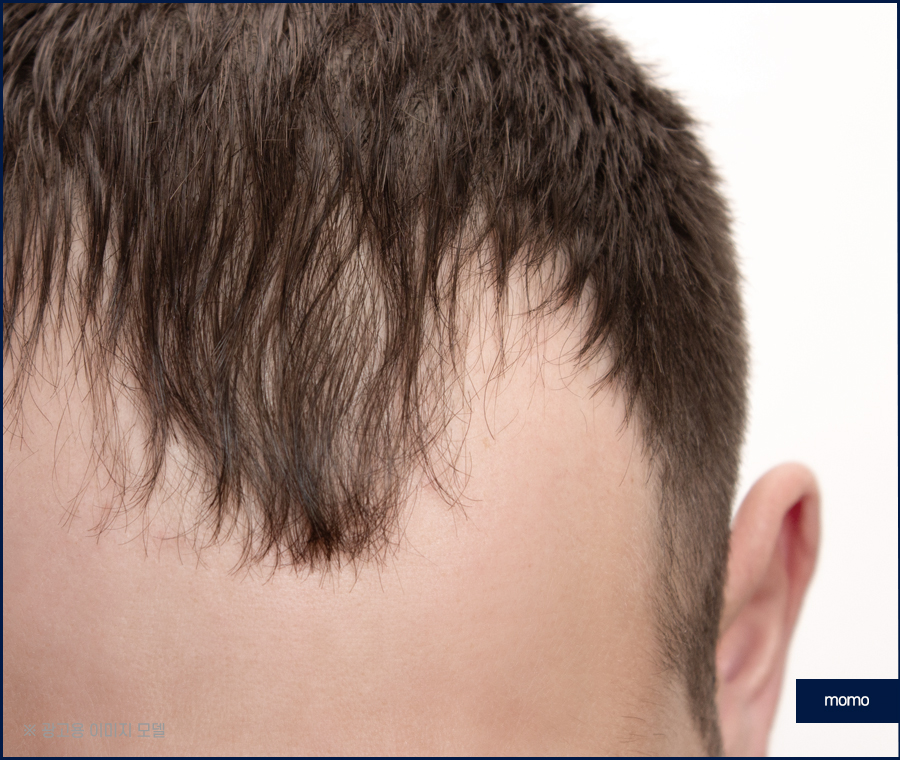 절개모발이식 차이점을 알고 정해야만 관련 이미지 9