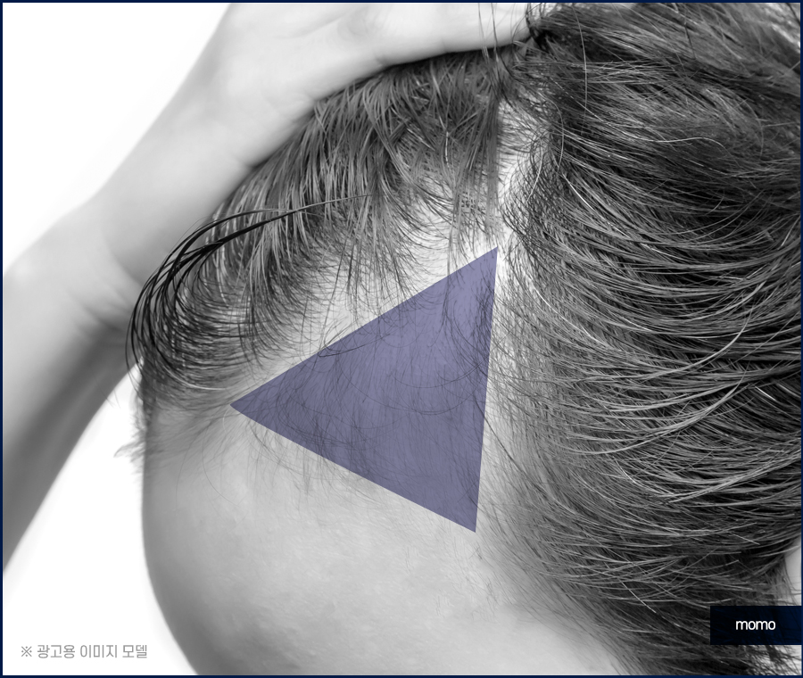 청소년 m자 탈모 요인 분석이 중요한 이유 관련 이미지 4