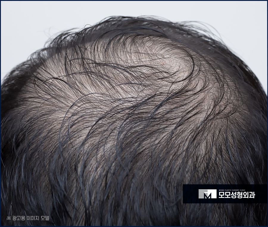 머리심는비용 풍성함에만 집중할 것이 아니라 관련 이미지 5