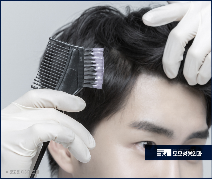 모발이식 6개월 차 변화와 유의할 점에 대해서 관련 이미지 6