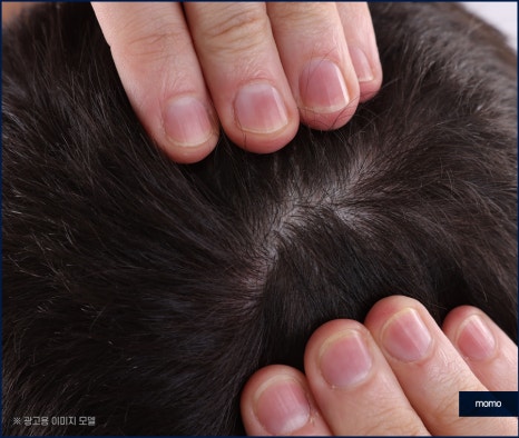 압구정역 모발이식 방법 및 생착률을 높이는 팁 관련 이미지 9