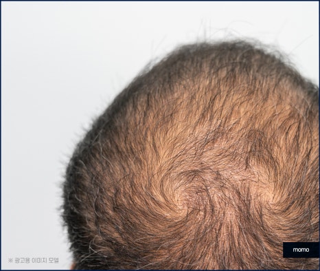 강남 모발이식 병원 차이가 나는 이유는 관련 이미지 8