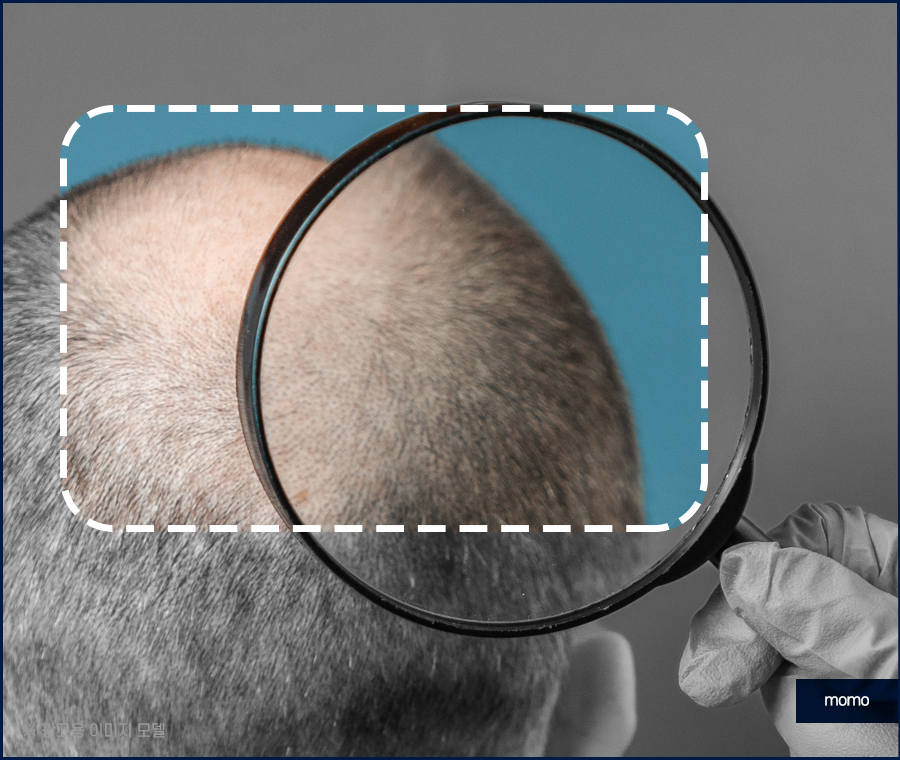 서울모발이식병원 나아지는 과정은 관련 이미지 7