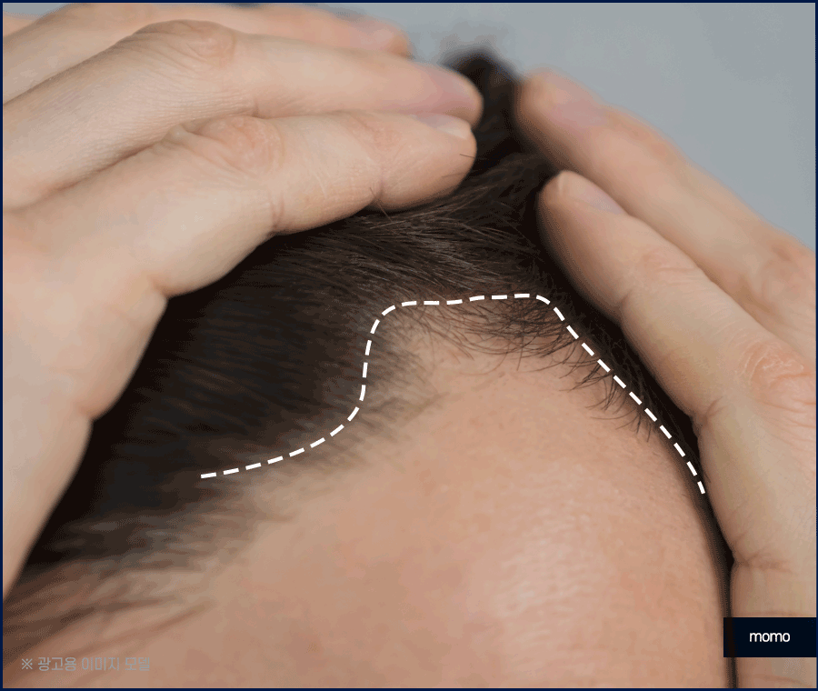 비절개 모발이식 후기와 함께 꼭 알아볼 이것! 관련 이미지 4