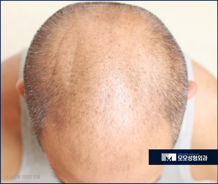 모발이식병원추천 중요한 기준에 대해 관련 이미지 2