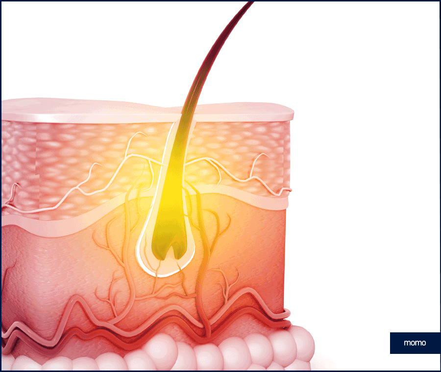 모발이식 2000모 자연스러운 커버 결과 정도는? 관련 이미지 3