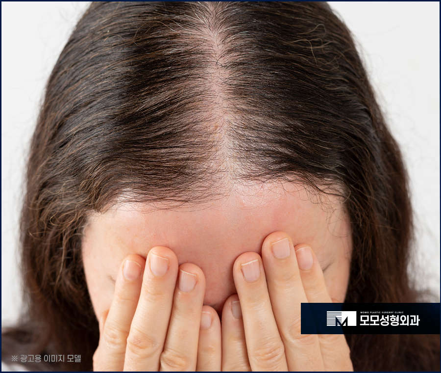 모발이식땀 나는 일은 생착률에 어떤 영향을 미칠까 관련 이미지 4