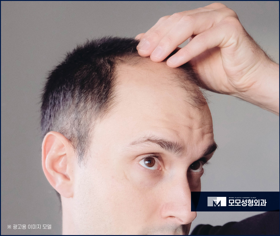 무삭발모발이식 신속한 회복으로 관련 이미지 2