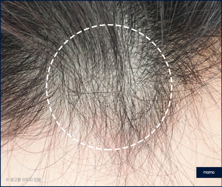 모발이식 생착률 기준짓는 요소들은 무엇일까 관련 이미지 7