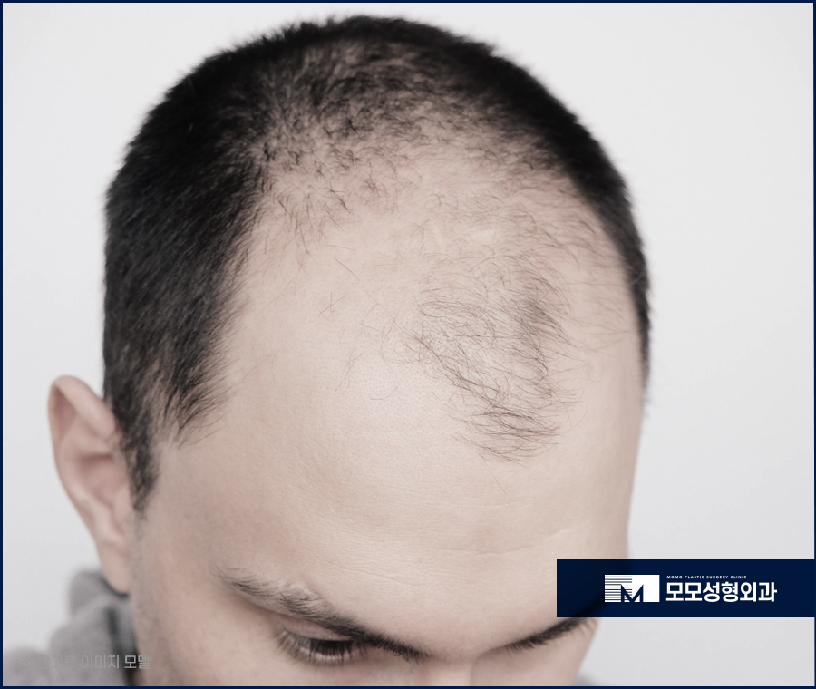 M자모발이식가격 충분한 보강을 원한다면 관련 이미지 4