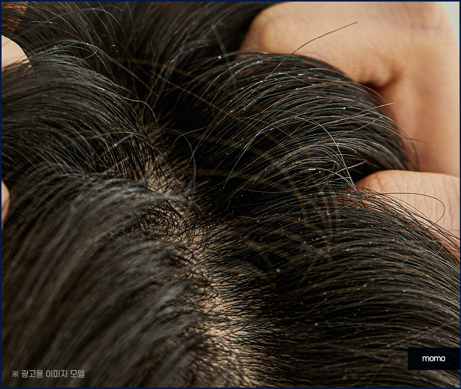 절개모발이식 차이점을 알고 정해야만 관련 이미지 4