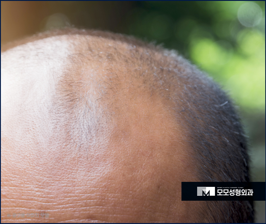 남자 앞머리 탈모 M자 라인 깊어짐이 보인다면 관련 이미지 3