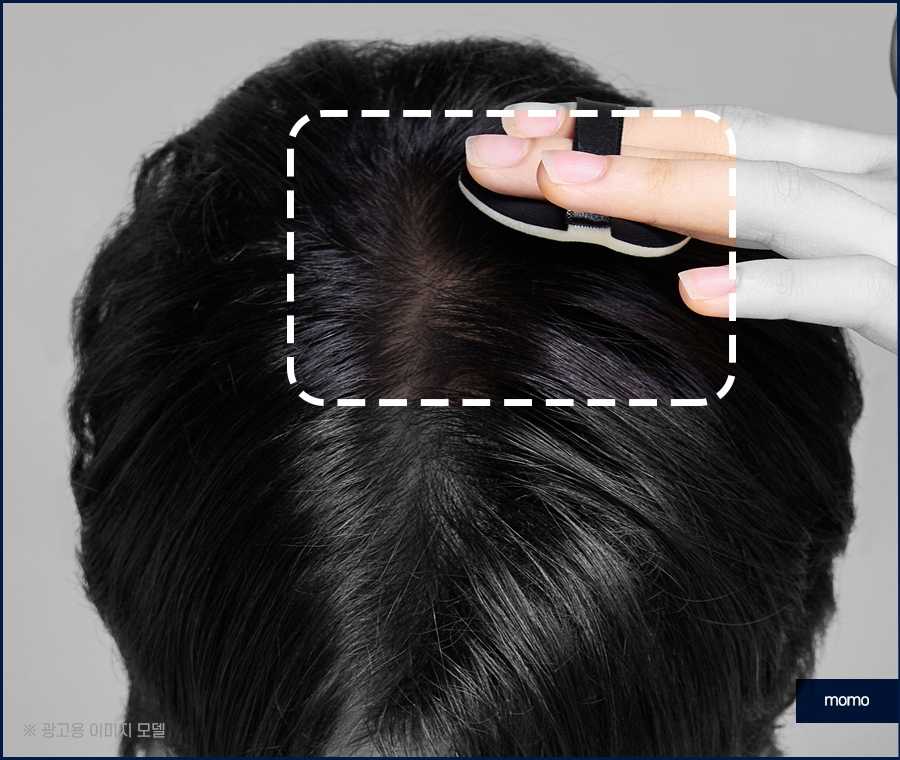 서울모발이식병원 나아지는 과정은 관련 이미지 3