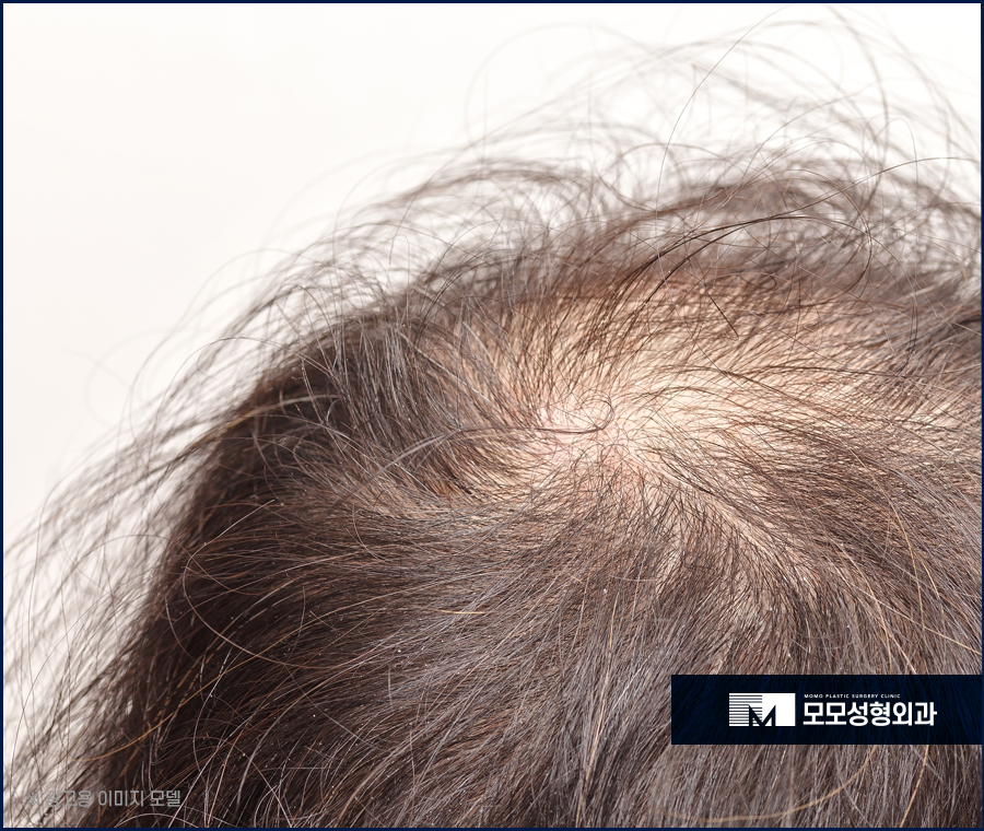 모발이얇아지는이유 그 원인부터 분명하게 알아야하는 관련 이미지 2