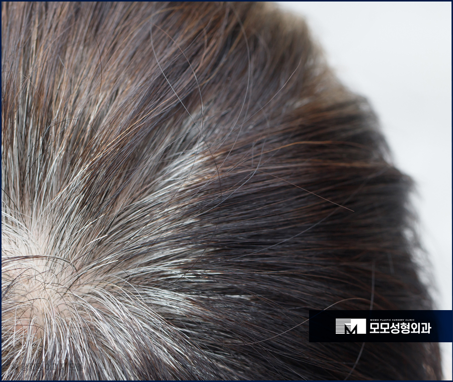 두피가아픈이유 어떤 원인들에 의해 나타날까요 관련 이미지 4