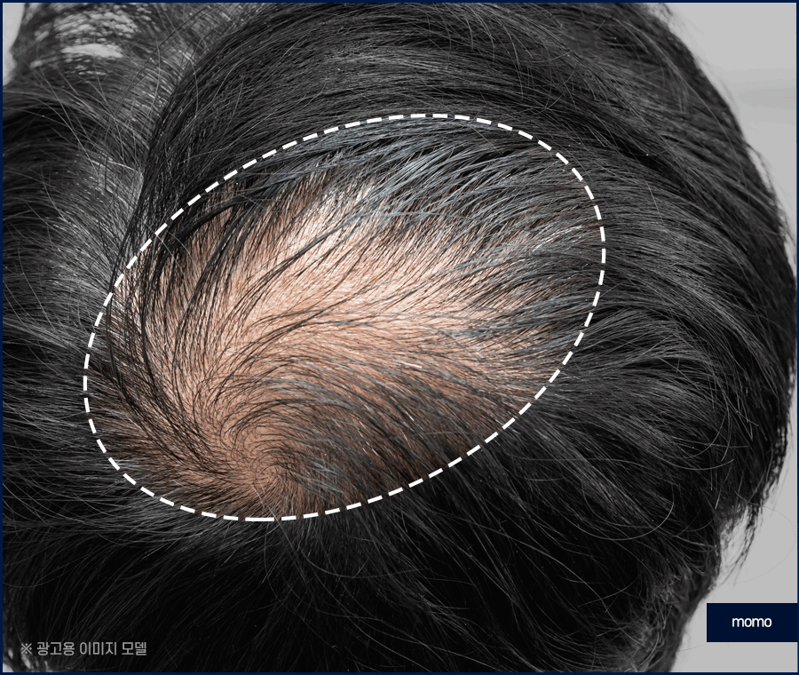 남자 탈모약으로 치료할 때 확인할 사항 관련 이미지 5