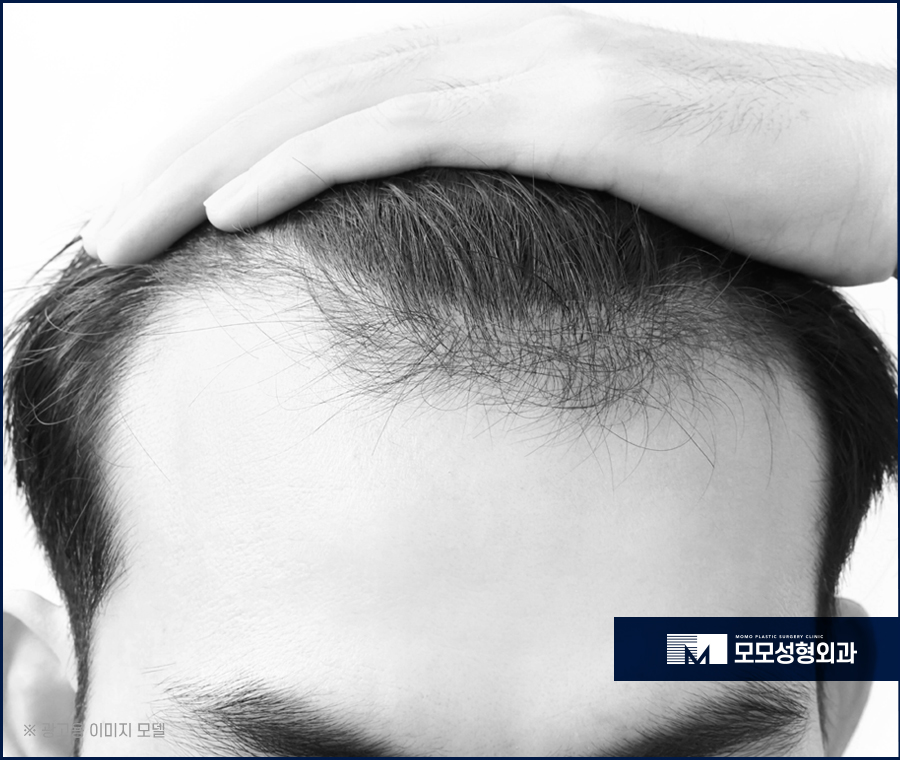 헤어라인교정비용 조건에 부합하는 수준은 관련 이미지 2