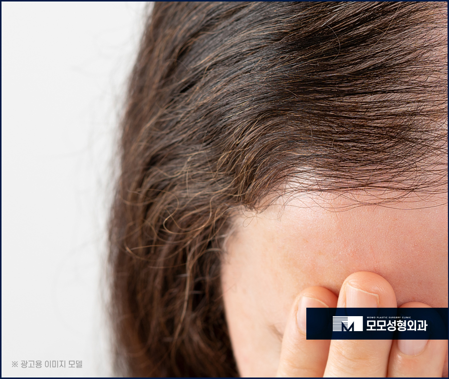 여성헤어라인모발이식 다양한 스타일링을 위해 관련 이미지 2