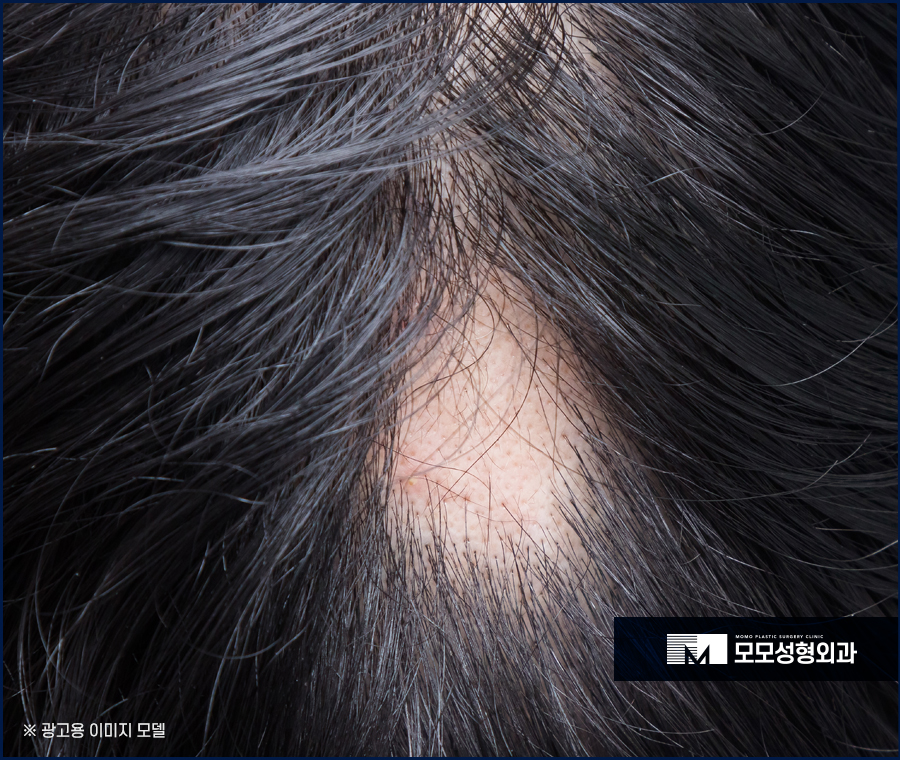 스트레스성탈모증상 다양하게 나뉘어 지는 관련 이미지 6