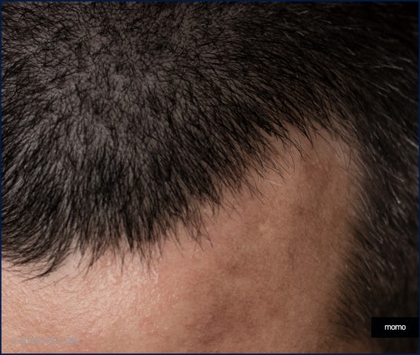 앞머리 모발이식 가격 차이부터 확인하며 관련 이미지 3