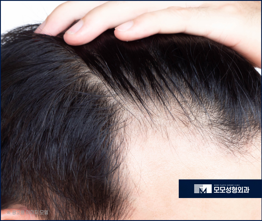 M자탈모약 효과적인 예후를 이뤄가는 관련 이미지 3