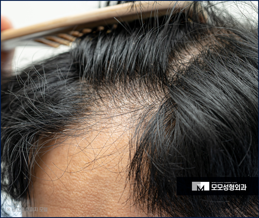 앞머리 모발이식 비용만큼 꼼꼼하게 알아봐야 할 점 관련 이미지 3