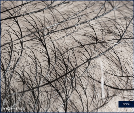 압구정 모발이식 탈모 문제를 해소하는 관련 이미지 5